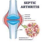 Infective Arthritis