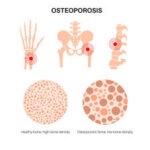 Bone disorders